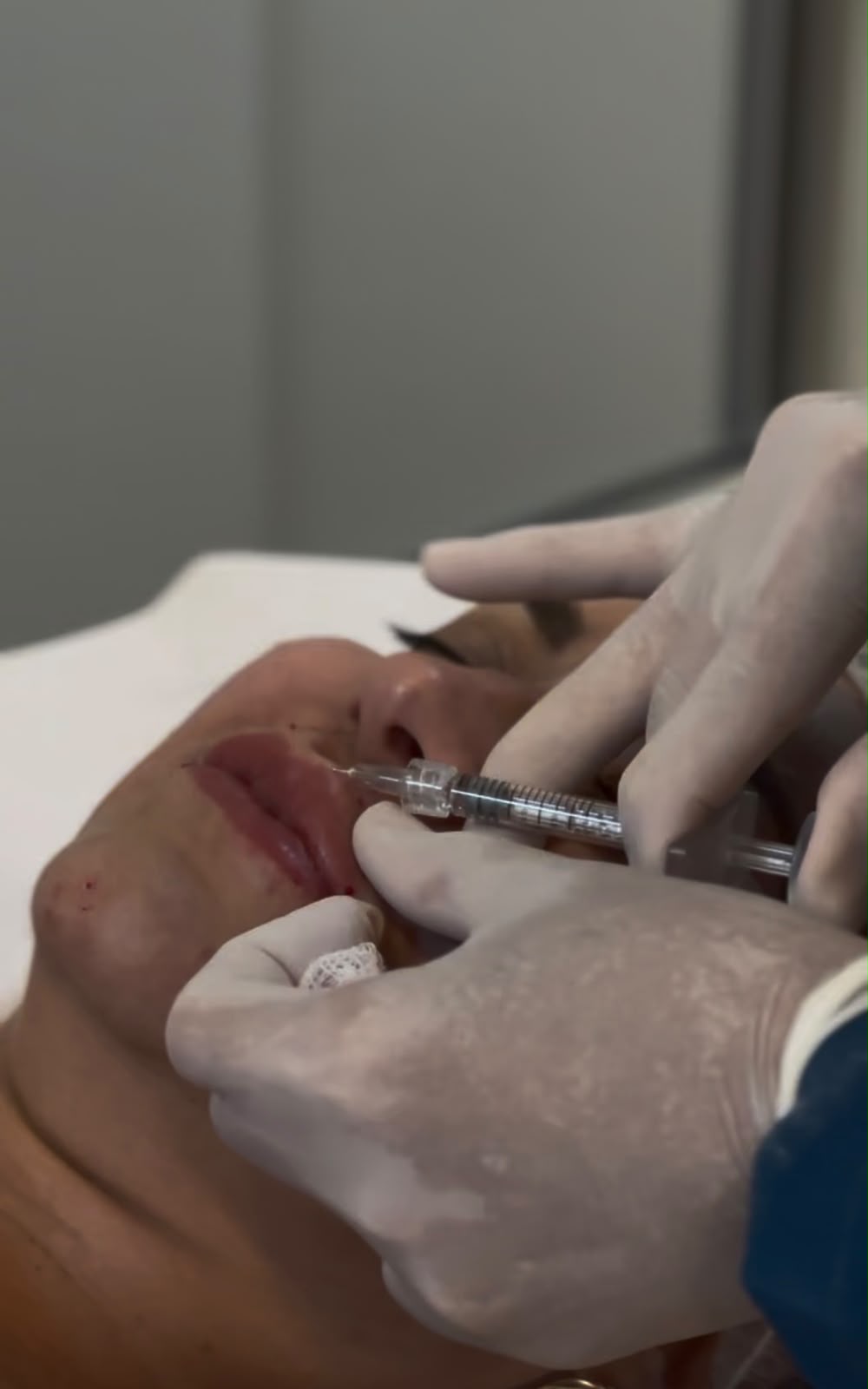 Procedimento de preenchimento labial realizado com técnica precisa